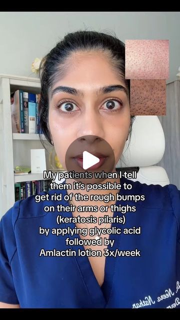 Dr. Neera Nathan on Instagram: "Keratosis pilaris (“strawberry skin” or “chicken skin”) presents as tiny rough bumps on the back of the arms or upper thighs. It appears as red, scaly bumps but can look hyperpigmented on dark skin. It is caused by excess dry skin around the hair follicle. Using products containing exfoliating acids, like glycolic acid toner followed by ammonium lactate lotion (like Amlactin) 3-4x per week can help treat this condition. Make sure to use a moisturizing lotion with ceramides on the other days. #keratosispilaris #strawberrylegs #fyp" How To Avoid Strawberry Skin, Keratosis Pilaris On Face, Pilaris Keratosis, Perioral Dermitis Skincare, Strawberry Skin, Red Moles, Glycolic Acid Toner, Strawberry Legs, Keratosis Pilaris