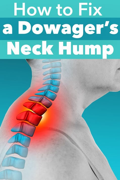 How To Reduce Back Neck Hump Women, Humpback Exercise, Dowagers Hump Correction, Dowagers Hump Correction Exercises, Dowagers Neck Exercises, Neck Exercises For Women, Get Rid Of Neck Hump, Buffalo Neck, Mantels Decor