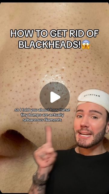 Black Head Remedies, Home Remedies For Blackheads, How To Extract Blackheads, How To Clear Blackheads On Nose, Best Way To Get Rid Of Blackheads, Face Black Spot Removal, How To Get Rid Of Blackheads At Home, How To Get Rid Of Blackheads Overnight, How To Remove Blackheads At Home