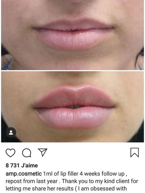 1 ml of lip filler 4 weeks follow up Different Styles Of Lip Filler, Hollywood Lips Filler, Lip Filler 2ml, Lip Filler Shape Ideas Pouty, Lip Filler Shape Ideas 1ml, Lip Fillers Before And After 1ml Russian, Keyhole Pout Lips, Lip Filler 1 Syringe, Lips Before And After Injections