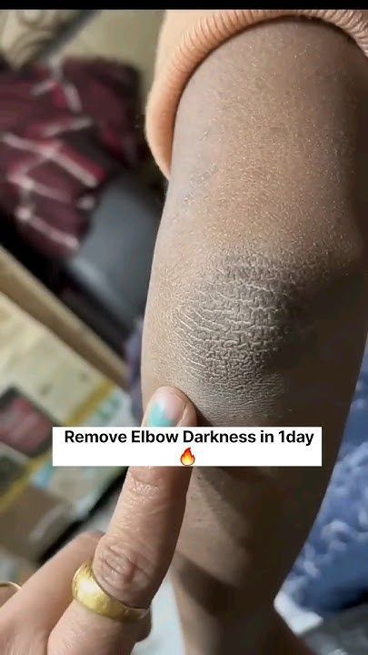 😱Get Rid of Dark Elbow/Get Fair Elbow In Just 1Day,RemoveSuntan #skincare#ytshorts#viral#viralvideo - YouTube Black Elbows Get Rid Of, How To Get Rid Of Corns On Toes, How To Get Rid Of Tanned Skin, Remove Dark Elbows, Black Neck Remedies, Good Skin Tips Skincare, How To Remove Body Tan, How To Glow Skin, How To Remove Blackheads From Nose