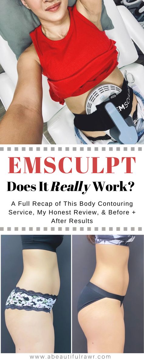 Body Sculpting Before And After, Em Sculpting Before And After, Cryoslimming Before And After, Body Contouring Aesthetic, Emsculpt Before And After, Cool Sculpting Before And After, Emsculpt Neo Before And After, Ems Sculpt, Emsculpt Neo