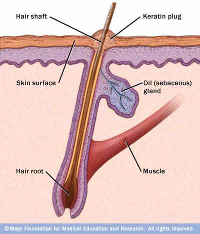 Keratosis pilaris develops when keratin forms a scaly plug that blocks the opening of the hair follicle. Usually plugs form in many hair follicles, causing patches of rough, bumpy skin.  - Mayo Clinic Infected Ingrown Hair, Glycolic Acid Cream, Sebaceous Filaments, Keratosis Pilaris, Bumpy Skin, Chicken Skin, Ingrown Hair, Roots Hair, Perfect Skin