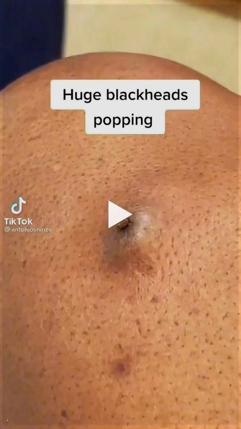 VIDEO : Satisfying Blackheads and Pores remova.. Blackhead Removal Diy, Diy Blackheads Removal, Blackheads Removal Homemade, Blackhead Removal Mask, Blackhead Removal Tool, Blackheads Removal Cream, Squeezing Blackheads, Nose Pimples, Blackheads On Face