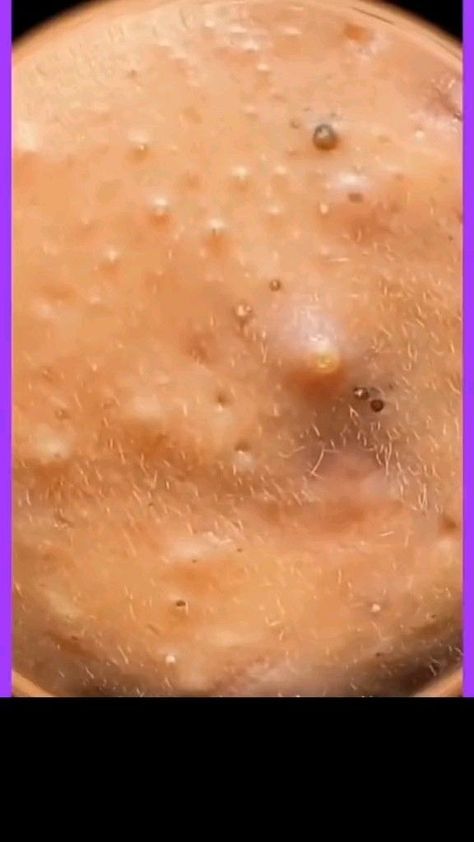 Blackheads Removal | Blackheads Removal Satisfying Videos | Blackheads Removal Homemade | Blackheads Removal Video Black Heads | Blackheads Removal Youtube | Blackheads Removal Diy | Blackheads Removal Video | Blackheads Removal Cream | Blackheads Removal Satisfying Videos Spa Clean Pores Videos, Acne Popping, Best Dark Spot Remover, Satisfying Zit Popping Videos, Pore Extraction, Pimple Pop, Pimple Extraction, Blackheads Popping Videos Faces, Popping Pimples