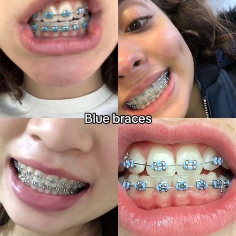 Brasses Teeth Color, Braces Colors Navy Blue, Cute Color Braces Ideas, Braces Sky Blue, Blue Braces Aesthetic, Braces Inspo Aesthetic, Blue Braces Colors, Braces Ideas Colors, Pink And Blue Braces