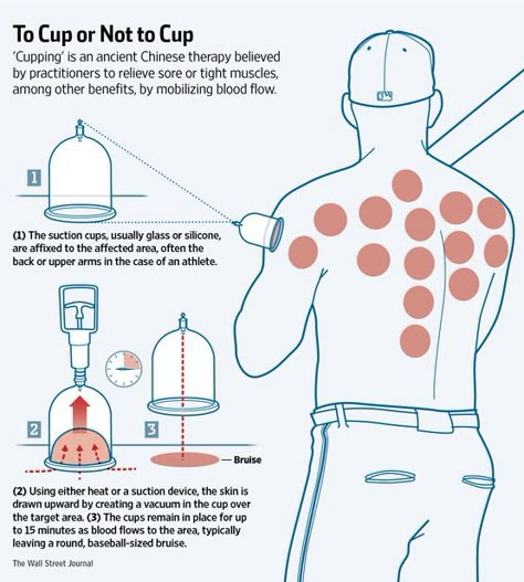 Cupping Therapy, Cupping Points, Hijama Cupping Therapy, Chinese Cupping, Benefits Of Cupping, Hijama Cupping, Fire Cupping, Massage Cupping, Acupuncture Benefits, Cupping Massage