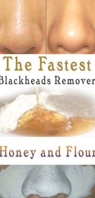 Pimples Overnight, Black Heads, Skin Care Routine For 20s, Homemade Lotion, How To Get Rid Of Pimples, Home Remedies For Hair, Smink Inspiration, Get Rid Of Blackheads, Natural Therapy