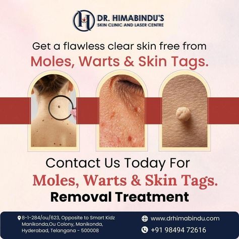 Modern Clinic, Skin Tags Removal, Warts Removal, Remove Skin Tags Naturally, Remove Warts, Too Much Estrogen, Mole Removal, Healthy Lifestyle Quotes, Botox Injections