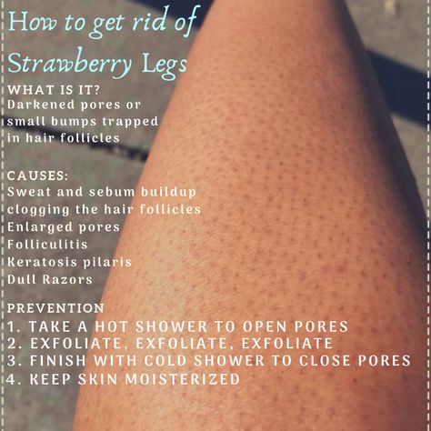 Bumpy Skin On Legs How To Get Rid, How To Get Rid Off Strawberry Skin, How Do You Get Rid Of Strawberry Skin, How To Get Rid Of Strawberry Skin Diy, How To Clear Strawberry Legs At Home, How To Keep Legs Smooth Longer, How To Get Rid Of Dry Skin On Legs Tips, How To Get Rid Of Dry Leg Skin, How To Get Rid Strawberry Skin