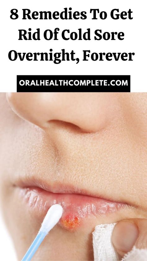 8 Remedies To Get Rid Of Cold Sore Overnight, Forever How To Get Rid Of A Cold Sore Overnight, Natural Cold Sore Remedies, Quick Cold Sore Remedy, Cold Sore Remedy Overnight How To Get Rid, Natural Remedies For Cold Sores, Best Cold Sore Remedy Overnight, Cold Sores Remedies Overnight, Home Remedies For Cold Sores, How To Get Rid Of A Cold Sore Fast