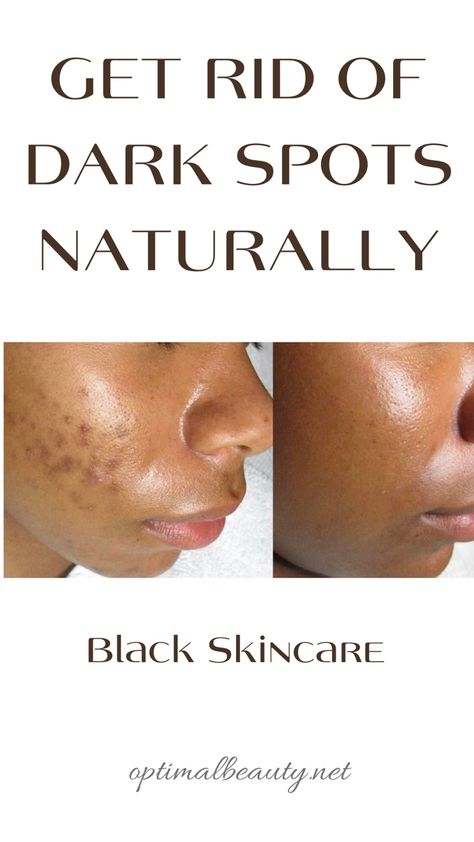 Black Skin Care Dark Spots, Bad Acne, Dark Spots On Face, Black Skin Care, Spots On Face, Remove Dark Spots, Skin Remedies, Skin Care Recipes, Face Skin Care