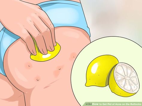 3 Ways to Get Rid of Acne on the Buttocks - wikiHow Buttocks Acne, Pimples On Buttocks, Acne Scar Remedies, Cystic Acne Remedies, Chest Acne, Forehead Acne, Acne Overnight, Natural Acne Remedies, Natural Acne