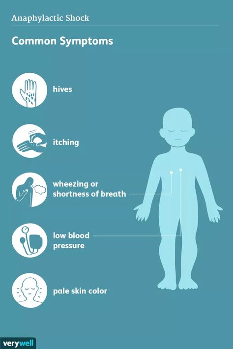 Anaphylaxis: Signs, Symptoms, and Complications Pale Skin Color, Brain Surgeon, Low Estrogen Symptoms, Anaphylactic Shock, Too Much Estrogen, Sciatic Nerve Pain, Low Blood Pressure, Emergency Care, Diy Hair Care