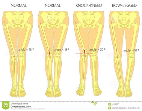 Knock Knees Correction, Genu Valgum, Genu Varum, Bow Legged Correction, Bone Infection, Knock Knees, Bow Legged, Drawing Tutorial Face, Lower Limb