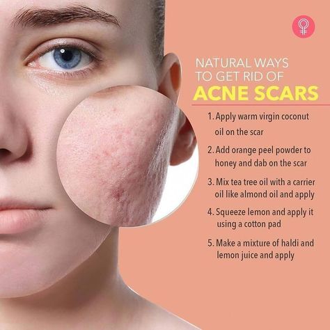 Acne Scar Remedies, Crochet Face Mask, Clear Skin Face, Clear Healthy Skin, Natural Skin Care Remedies, Get Rid Of Acne, Natural Face Skin Care, Rid Of Acne, Good Skin Tips