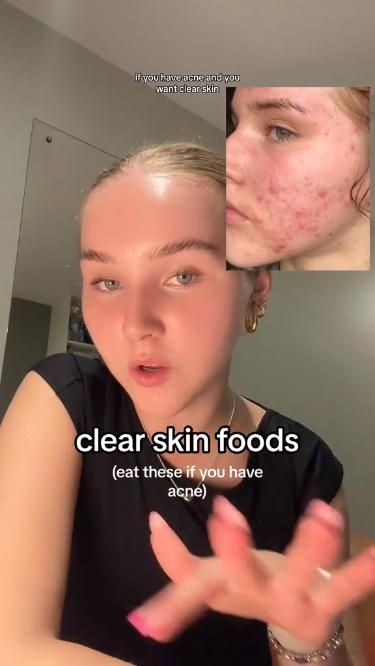 Eat these to clear acne 💪 Foods For Clear Skin, Skin Foods, Clear Skin Diet, Acne Diet, Acne Free Skin, Skin Diet, Serious Skin Care, Natural Acne Remedies, Clear Skin Tips