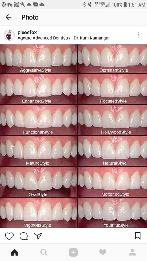 Cosmetic Dentistry Procedures, Veneers Teeth, Dental Anatomy, Beautiful Teeth, Porcelain Veneers, Perfect Teeth, Teeth Shape, Dental Veneers, Smile Teeth