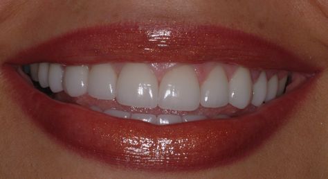 Nice Smile Teeth, Perfect Teeth Aesthetic, Natural Veneers, Short Teeth, Teeth Aesthetic, Pretty Teeth, Veneers Teeth, Discolored Teeth, Beautiful Teeth