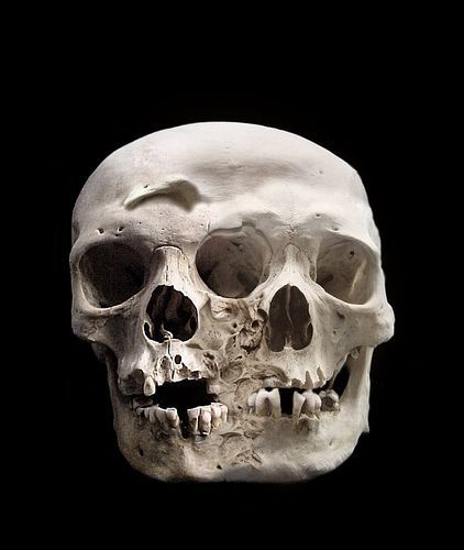 Fused heads, Mutter Museum. Picture by Zenosaurus #skull Skull Reference, Human Oddities, 31 Days Of Halloween, Human Skull, Poses References, Arte Inspo, Anatomy Reference, Skeletal, Anatomy Art