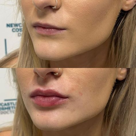 #plasticsurgery #plasticsurgerygonewrong #beforeafter #celebritiesbeforeafter #hollywoodstars #bignosesurgery #surgery #facesurgery #vlinesurgery #koreanplasticsurgery #kpopplasticsurgery #nosejob #jawreductionsurgery #eyesurgery #cheekfillers #rhinoplasty #facelift #plasticsurgeryfails #expensiveplasticsurgery Simple Lip Fillers, Before And After Lip Fillers Small Lips, Lip Flip And Filler Before And After, Lip Filler Smile Before And After, Lip Filler On Small Mouth, Healed Lip Filler, Volbella Lips Before And After, One Syringe Lip Filler, Small Mouth Lip Fillers