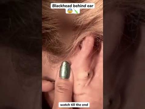 Blackhead Behind Ear #oddlysatisfying #sick #blackhead #pimplepopper #satisfying #cyst #wow #acne Blackheads Removal Cream, Closed Comedones, Ear Pimple, Big Pimple, Cystic Acne Remedies, Cystic Pimple, Dilated Pores, Blackhead Remover Diy, Clear Skin Routine