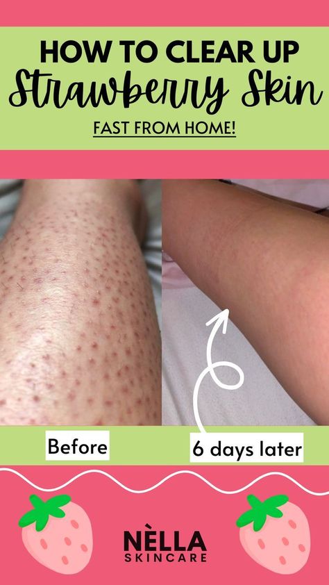 How I cleared up my Strawberry Legs Fast from Home Kp Skin, Kp Bump Eraser, Bump Eraser, Strawberry Skin, Natural Scrub, Strawberry Legs, Keratosis Pilaris, Cold Sores Remedies, Sleep Remedies