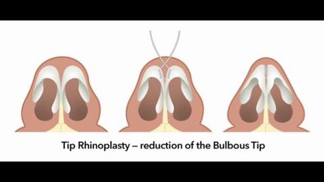 Nose Reduction, Bulbous Nose Rhinoplasty, Bulbous Nose Rhinoplasty Before After, Nose Plastic Surgery, Bulbous Nose, Nose Reshaping, Rhinoplasty Before And After, Aesthetic Dermatology, Rhinoplasty Nose Jobs