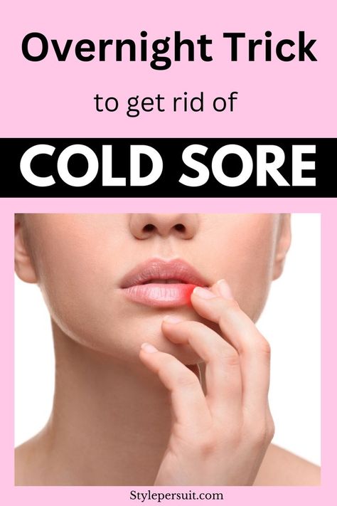 Here are the best cold sore remedies to alleviate symptoms and speed up healing, as well as prevention tips to help reduce the chances of future outbreaks. Cold Sore Scab, Cold Sore Remedy Overnight, Cold Sore Remedies, Natural Cold Sore Remedy, Cold Sore Relief, Get Rid Of Cold, Fever Blister, Natural Remedies For Migraines, Cold Sores