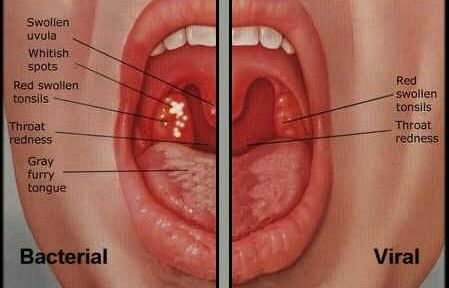 Bacterial vs Viral Sore Throat Swollen Uvula, Throat Ulcers, Swollen Tonsils, Throat Remedies, Sore Throat Remedies, Low Sodium Recipes Blood Pressure, Throat Pain, Throat Infection, Blood Pressure Symptoms