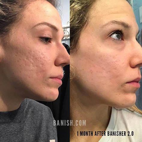 Fade acne scars, fine lines, and dark spots with the Banisher 2.0 Microneedle stamp tool. Microneedling at home made easy, safe, and effective. Hyperpigmentation Mask, Skin Wars, Remove Skin Tags Naturally, Bad Acne, Natural Acne Remedies, Acne Scar, Get Rid Of Blackheads, Saggy Skin, Derma Roller