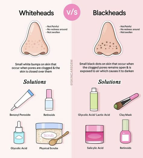 How to prevent black heads and whiteheads what are they what products to use to treat whitehead and black heads Things That Are Good For Your Skin, How To Clear Whiteheads On Nose, Black Head Skin Care, How To Get Rid Of Black Heads, How To Get Rid Of White Heads, Whiteheads Removal, Beauty Treatments Skin Care, Skin Advice, Basic Skin Care