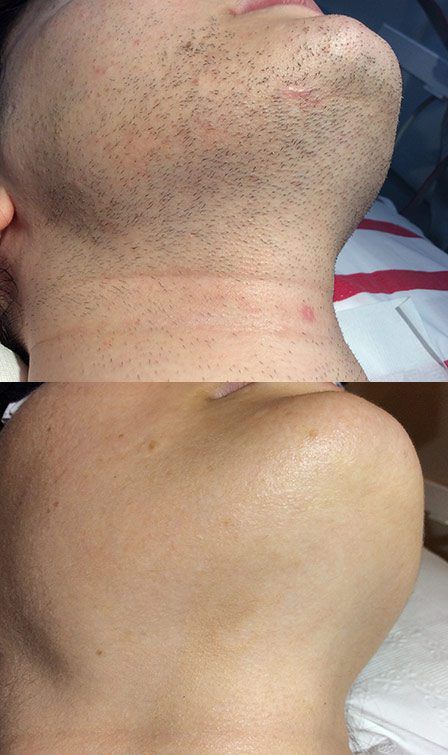 Are you looking for a permanent hair removal method? Permanence is here to help. We offer our permanent, safe, and effective hair removal for men using our unique galvanic multi-probe electrolysis method. What's more, we will permanently remove your unwanted hair from all body and facial areas. Call now! Laser Hair Removal Men, Permanent Facial Hair Removal, Electrolysis Hair Removal, Remove Unwanted Hair, Permanent Hair Removal, Underarm Hair Removal, Hair Removal For Men, Remove Hair, At Home Hair Removal