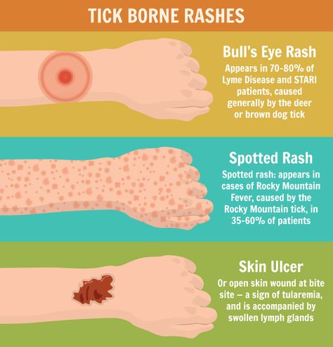 Tick Bite Rash, Tick Bites On Humans, Essential Oils For Fleas, Types Of Ticks, Natural Tick Repellent, Hiking Safety, Lymph Glands, Tick Removal, First Aid Tips