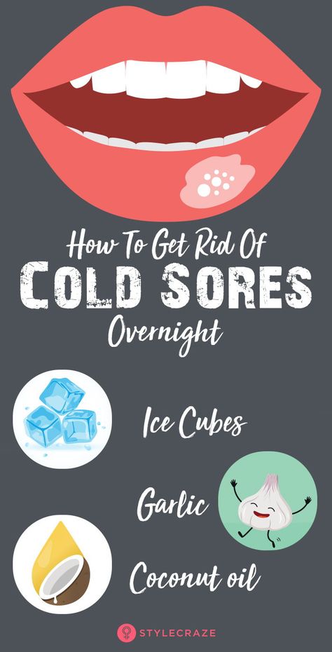 Cold Sore Remedy Fast, Cold Sore Remedy Overnight, Fever Blister Remedy, Cold Sore Lip, Blister Remedies, Get Rid Of Cold, Fever Blister, Essential Oils For Colds, Cold Sores