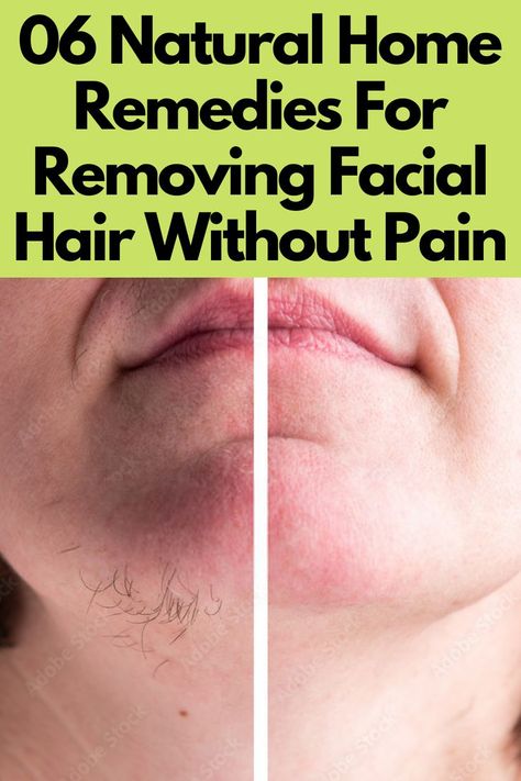 06 Natural Home Remedies For Removing Facial Hair Without Pain Removing Facial Hair Women, Removing Facial Hair, Homemade Hair Removal, Natural Facial Hair Removal, Diy Facial Hair Removal, Female Facial Hair, Best Facial Hair Removal, Face Hair Removal, Hair Removal Diy