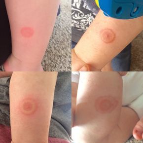 Are tick bites itchy? Do they always cause a rash? Here are the telltale symptoms of a tick bite, plus pictures that can help you identify one if you suspect you've been bitten. Tick Bite Rash, Tick Bites On Humans, Tick Bites Pictures, Tick Bite Symptoms, Lyme's Disease, Wood Tick, Types Of Rashes, Tick Removal, Fall Fitness