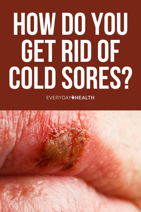 How Do You Get Rid of Cold Sores? What Causes Cold Sores? What Is a Cold Sore? Are Cold Sores Herpes? Are Cold Sores Contagious? What Does a Cold Sore Look Like? How Do You Prevent Cold Sores? What’s the Best Thing to Put on a Cold Sore? What Shouldn’t You Use on One? How Do You Cover Up a Cold Sore? How Common Are Cold Sores? Can You Pop a Cold Sore? Got questions about cold sores? Here’s a look at 10 frequently asked questions to help you recognize, treat, and avoid these blisters. How To Prevent Cold Sores, How To Get Rid Of Cold Sores, Cold Sore Remedy Overnight, Blister On Lip, Cold Sore Prevention, Cold Sore Relief, Get Rid Of Cold, Fever Blister, Home Remedies For Cold