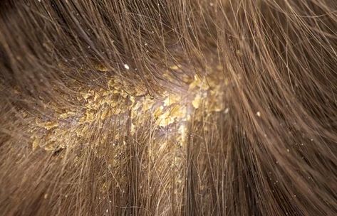 Different Types Of Dandruff And How To Stop Them Scalp Scabs, Scaly Scalp, Flakey Scalp, How To Remove Dandruff, Dry Scalp Remedy, Dry Flaky Scalp, Dandruff Causes, Oils For Dandruff, Dandruff Flakes