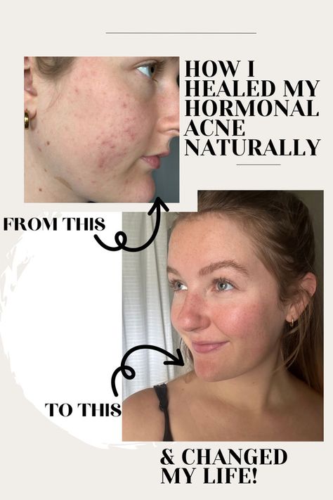 Hormonal acne is not fun at all.. and to be honest, neither is the healing journey. But it is so worth it to learn how to tune into your body, and make necessary changes for your health and life! Healing acne naturally. Acne Around Mouth, Acne Between Eyebrows, Mask For Acne Skin, Coming Off Birth Control, Hormonal Acne Skincare Routine, Hormonal Acne Skincare, Layering Skincare, Face Masks At Home, Skin Treatments For Acne