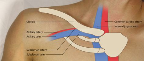 Ultrasound-Guided Subclavian Vein Cannulation: Procedures - Introduction | SonoSim Subclavian Vein, Ultrasound, Anatomy, Right Now