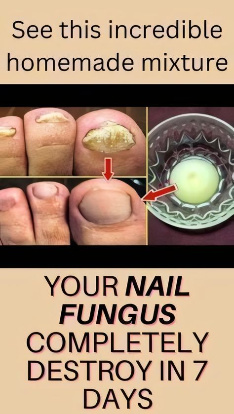 Fungal Nail Infections Cleaning Wounds, Nail Fungus Remedies, Toenail Health, Nail Fungus Remedy, Coconut Oil Skin Care, Toenail Fungus Remedies, Nail Infection, Fungal Nail, Nail Care Routine