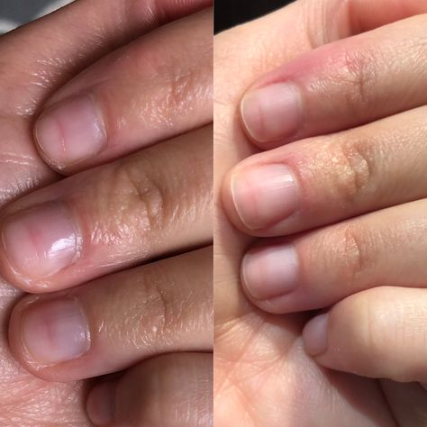 My Recovery From Nail Damage — ThePolishedPA Nail Bed Damage, Short Nail Bed, Nail Discoloration, Nails After Acrylics, Nail Problems, Nail Infection, Fungal Nail, Nail Repair, Damaged Nails