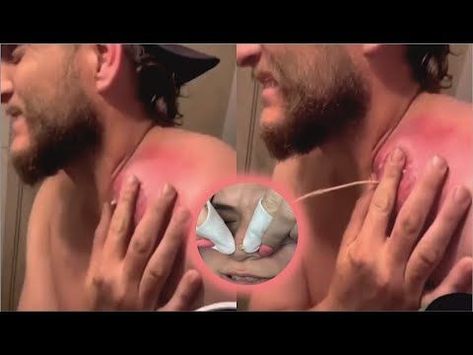 Popping Huge Blackheads and Pimple Popping - Best Pimple Popping Videos 06 Huge Pimple Poppìng, Pimple Pops Videos, Spot Popping Videos, Dr Pimple Poppìng Videos, Huge Blackheads Extraction Videos, Ear Pimple Poppìng Videos, Huge Pimple Pop Video, Arm Pimples, Leg Pimples