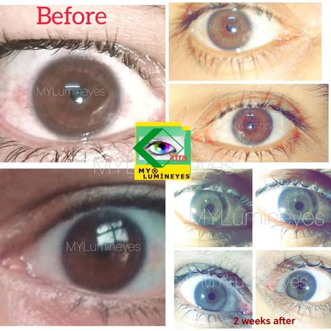 Change your eye color from brown to green or blue naturally by Lumineyes laser eye color change surgery. #lumineyes #lasereyecolorchange #lumineyesxtra #drmustafamete #eyecolorchangelaser #blueeyes #mylumineyes #eyecolorchangesurgery https://mylumineyes.com/ Iridology Reading, Eye Color Change Surgery, Woman Eyes, Change Your Eye Color, Heart Diet, Laser Eye, Glow Up Tips, Plastic Surgery, Green Eyes