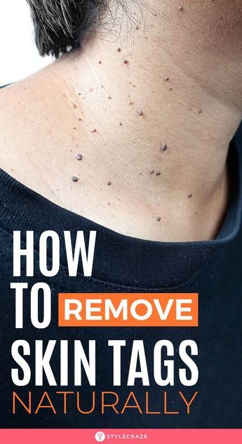 Remove Skin Tags Naturally, Remove Skin Tags, Cold Sore Remedies, Home Remedies For Skin, Cold Sores Remedies, Natural Sleep Remedies, Skin Tags, Natural Cold Remedies, Glow Skin