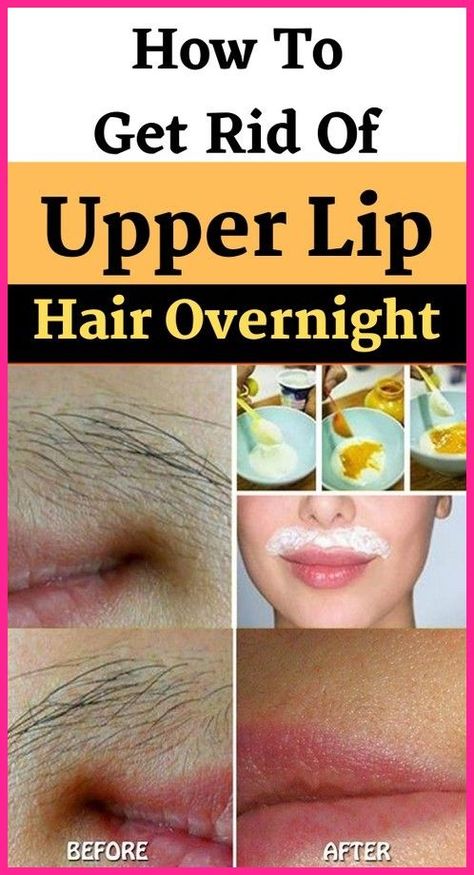 Permanent Hair Removal At Home, Natural Hair Removal Remedies, Best Permanent Hair Removal, Female Facial Hair, Upper Lips, Electrolysis Hair Removal, Hair Removal At Home, Lip Hair Removal, Upper Lip Hair