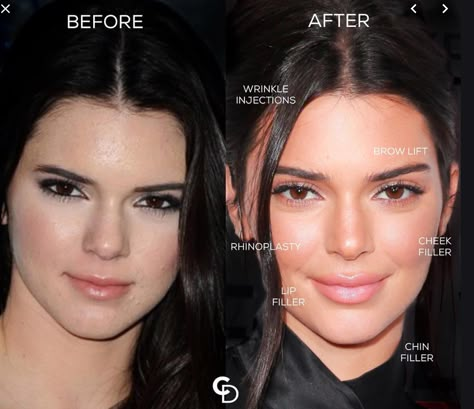 Kendall Jenner Surgery, Kendall Jenner Nose Job, Kendall Jenner Plastic Surgery, Skin Tags On Face, Skin Tags Removal, Face Plastic Surgery, Remove Skin Tags Naturally, Kendall Jenner Face, Rhinoplasty Nose Jobs