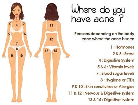 where do you have acne? Body Chart, Natural Acne Remedies, Natural Acne, Body Acne, Natural Healing Remedies, Acne Breakout, Cystic Acne, Acne Remedies, Natural Therapy