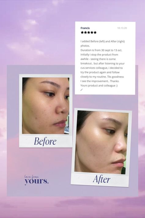 Before and after pictures and customer review for personalized skincare Supplements Branding, Day And Night Skincare Routine, Day And Night Skincare, Glowy Dewy Skin, Testimonial Design, Contents Ideas, Medical Branding, Night Skincare Routine, Boho Instagram